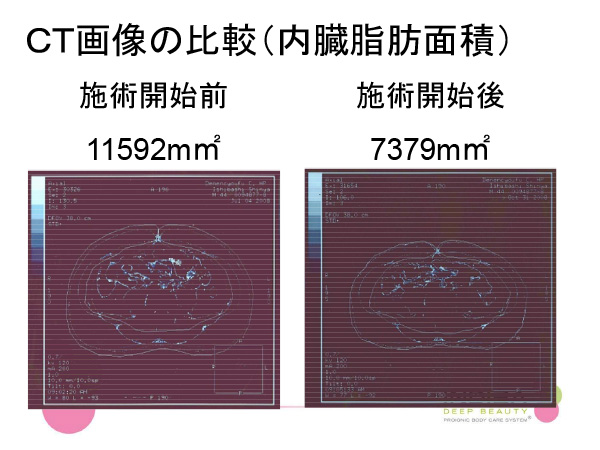 CT画像での内臓脂肪面積比較ビフォーアフター(インディバ)