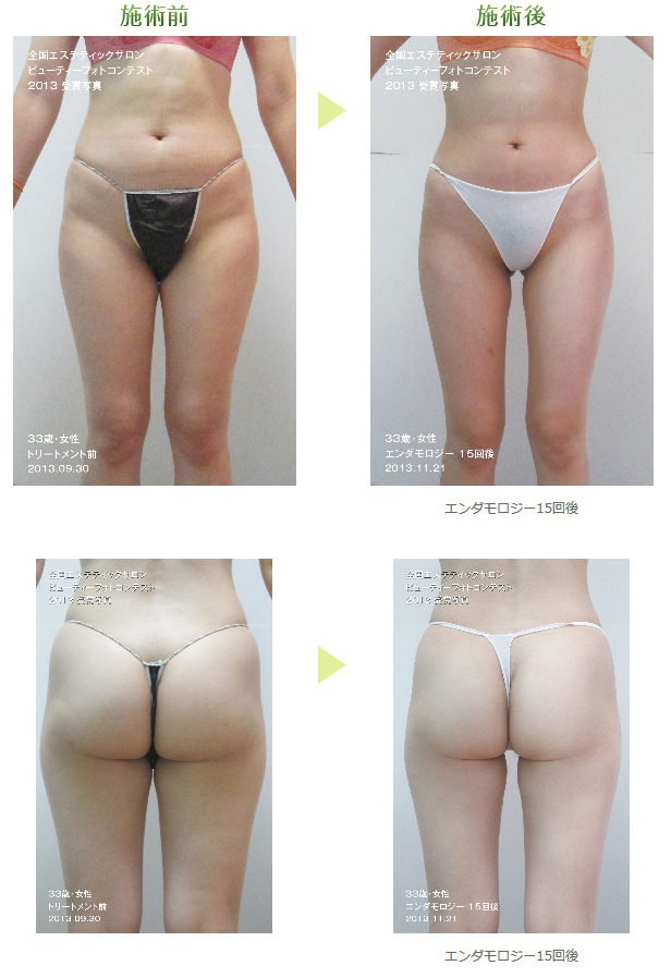 インテグラルスリムの施術前施術後