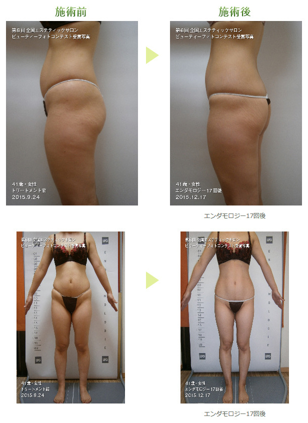 インテグラルスリムの施術前施術後